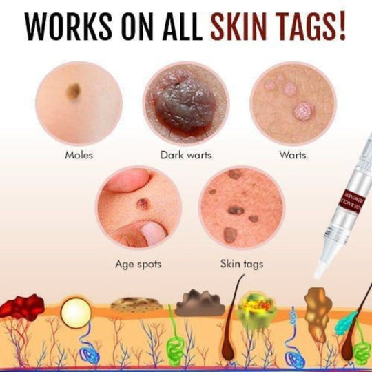 Skin Tags and Moles Remover with Tea Tree Oil and Borneol Formula