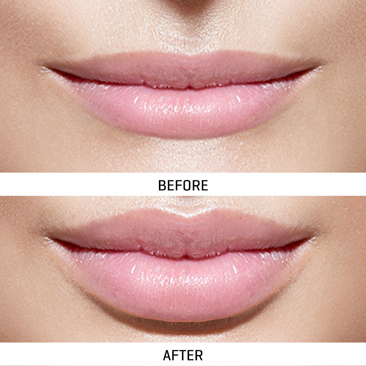 World's First At-Home Professional LED Lip Therapy Device